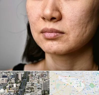 سابسیژن جای جوش در منطقه 18 تهران 