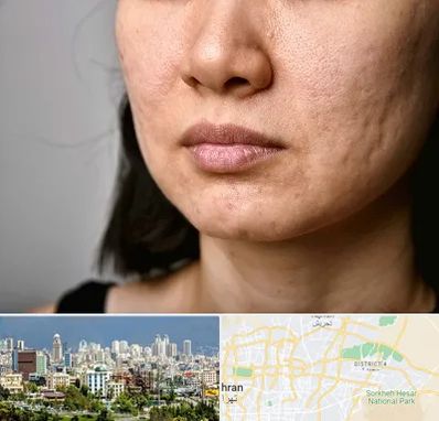 سابسیژن جای جوش در شرق تهران 