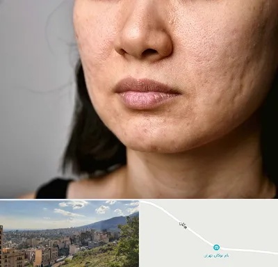 سابسیژن جای جوش در بوکان تهران