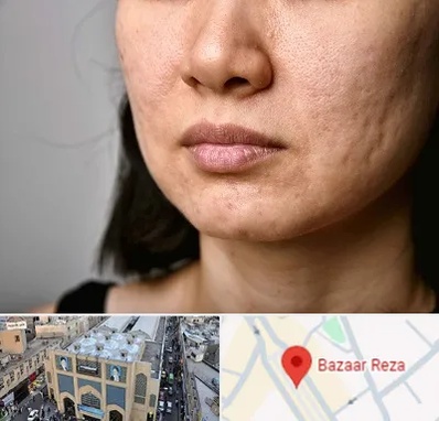 سابسیژن جای جوش در بازار رضا مشهد