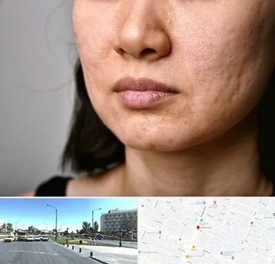 سابسیژن جای جوش در بلوار کلاهدوز مشهد 