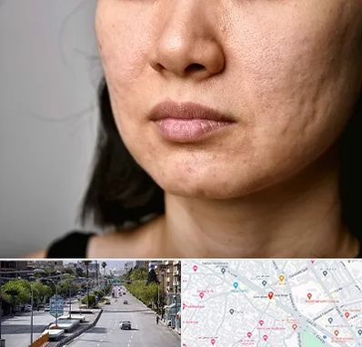 سابسیژن جای جوش در خیابان زند شیراز