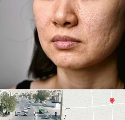 سابسیژن جای جوش در هاشمی