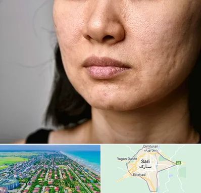 سابسیژن جای جوش در ساری