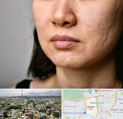 سابسیژن جای جوش در گیشا 