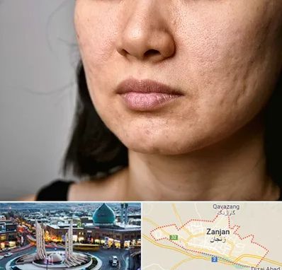 سابسیژن جای جوش در زنجان