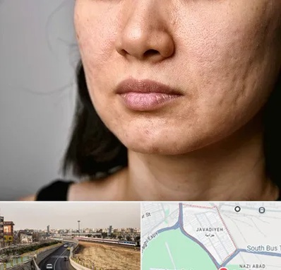 سابسیژن جای جوش در جوادیه