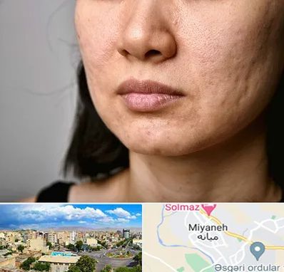 سابسیژن جای جوش در میانه