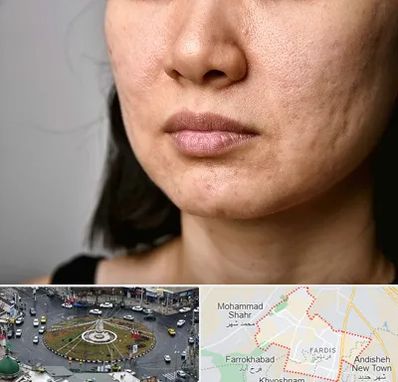 سابسیژن جای جوش در فردیس کرج 