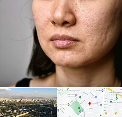 سابسیژن جای جوش در هنگام 