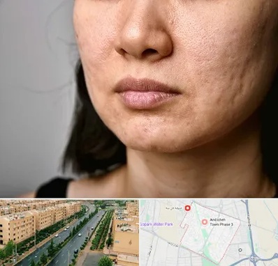 سابسیژن جای جوش در فاز سه اندیشه