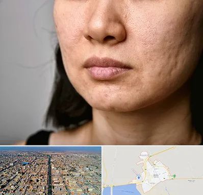 سابسیژن جای جوش در بندر ماهشهر