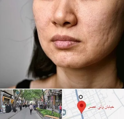 سابسیژن جای جوش در ولیعصر شهریار