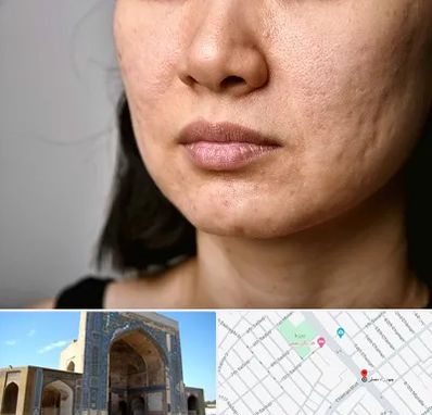 سابسیژن جای جوش در مصلی مشهد