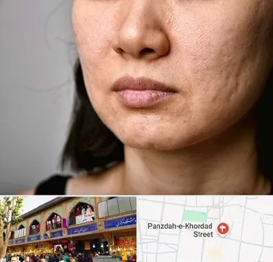 سابسیژن جای جوش در 15 خرداد