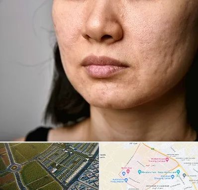 سابسیژن جای جوش در الهیه مشهد