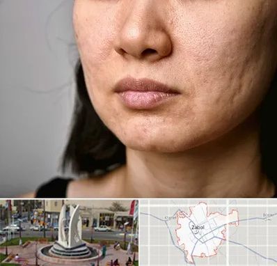 سابسیژن جای جوش در زابل