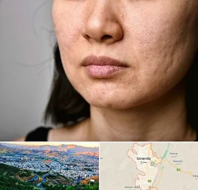 سابسیژن جای جوش در سنندج