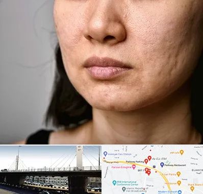 سابسیژن جای جوش در پارک وی 