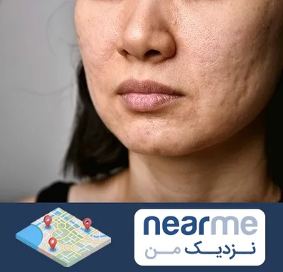 سابسیژن جای جوش در نزدیک من