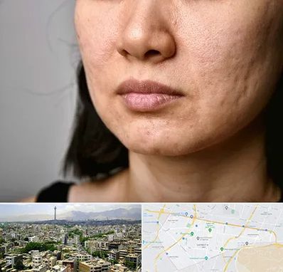 سابسیژن جای جوش در منطقه 8 تهران 