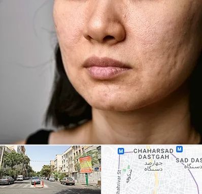 سابسیژن جای جوش در چهارصد دستگاه 