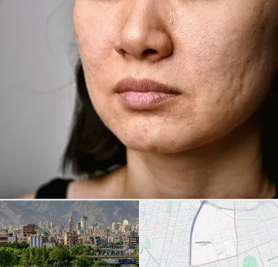 سابسیژن جای جوش در جمشیدیه