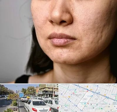 سابسیژن جای جوش در مفتح مشهد