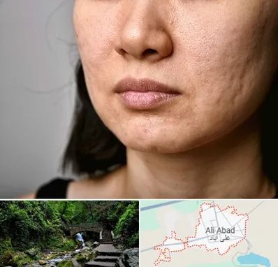 سابسیژن جای جوش در علی آباد کتول
