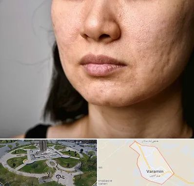 سابسیژن جای جوش در ورامین