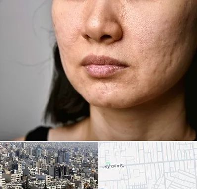 سابسیژن جای جوش در جیحون