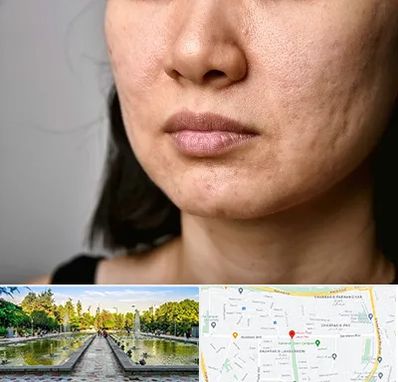 سابسیژن جای جوش در سرسبز 