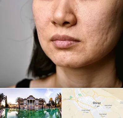 سابسیژن جای جوش در شیراز