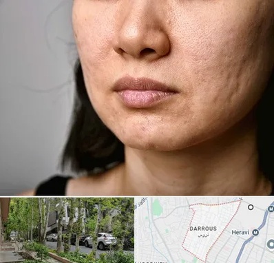 سابسیژن جای جوش در دروس