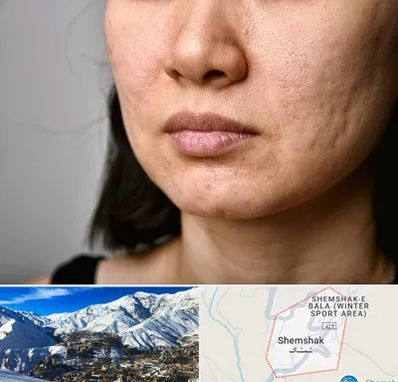 سابسیژن جای جوش در شمشک