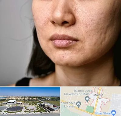 سابسیژن جای جوش در ملارد