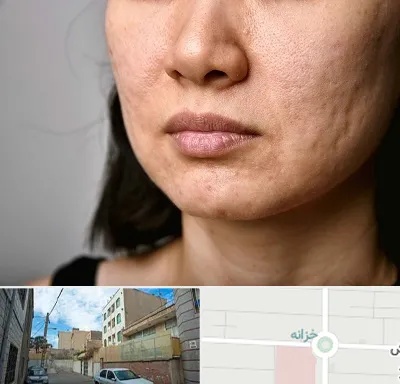 سابسیژن جای جوش در خزانه