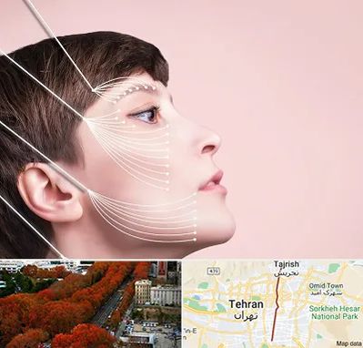 اندولیفت پیشانی در ولیعصر 