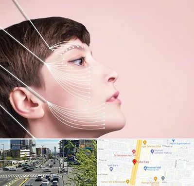 اندولیفت پیشانی در ستاری 