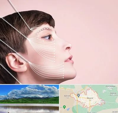 اندولیفت پیشانی در مرند