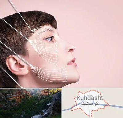 اندولیفت پیشانی در کوهدشت