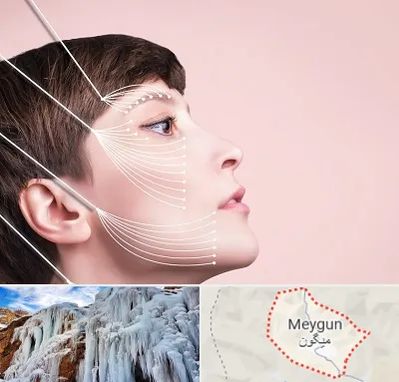 اندولیفت پیشانی در میگون