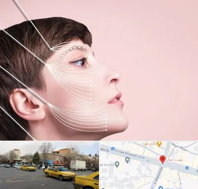 اندولیفت پیشانی در شهناز تبریز