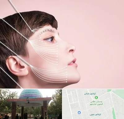 اندولیفت پیشانی در کیانشهر