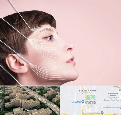 اندولیفت پیشانی در اکباتان 