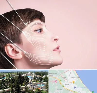 اندولیفت پیشانی در رودسر