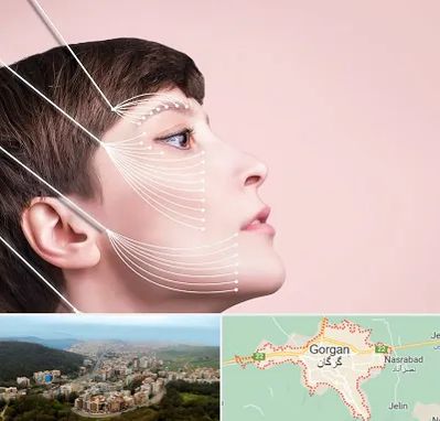 اندولیفت پیشانی در گرگان