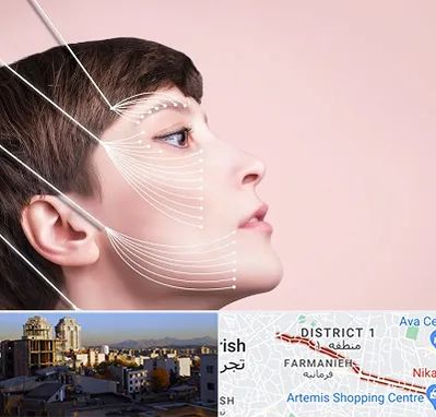 اندولیفت پیشانی در فرمانیه 