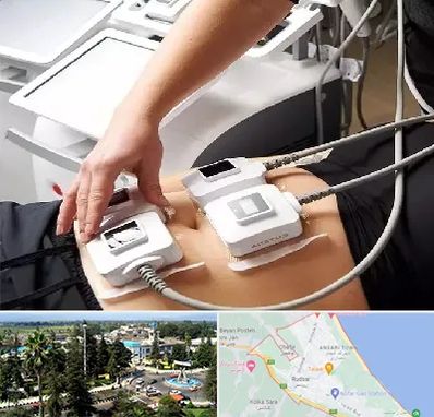 ترواسکالپ در رودسر