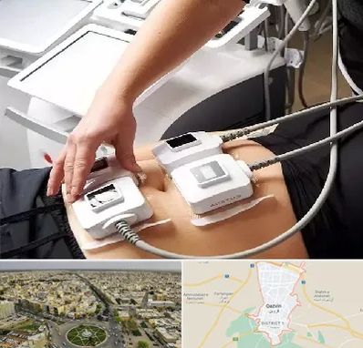 ترواسکالپ در قزوین